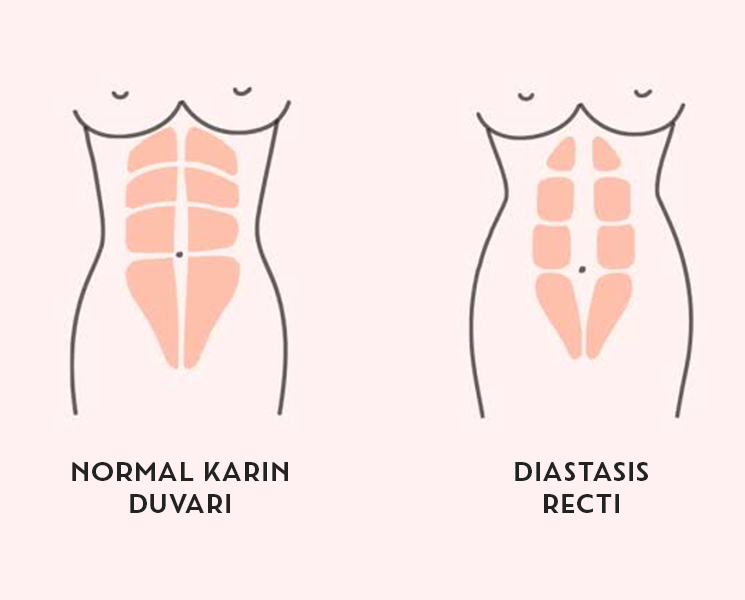 Diastasis Recti Nedir