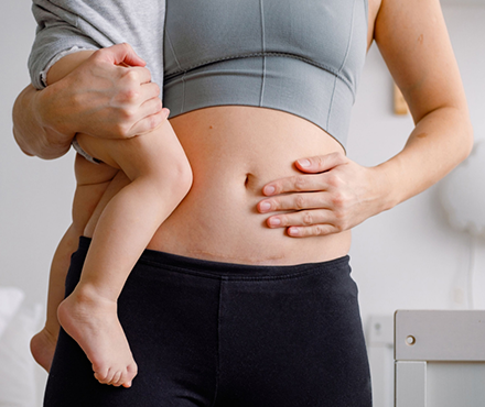 Diastasis Recti Nedir